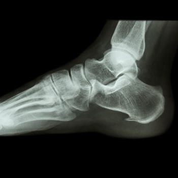 Foot X Ray Of Construction Worker After Injury
